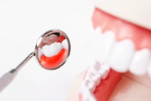 La difference entre gingivite et parodontite​